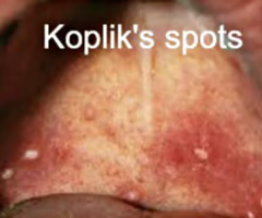 <p>tiny white spots from measles (rubeola) that appear in the mouth 2 days before rash that begins on face and spreads downward</p>