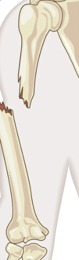 <p><strong><em>a fracture in which there is an open wound or break in the skin</em></strong><span style="font-family: Roboto, Arial, sans-serif"> near the site of the broken bone.</span></p>