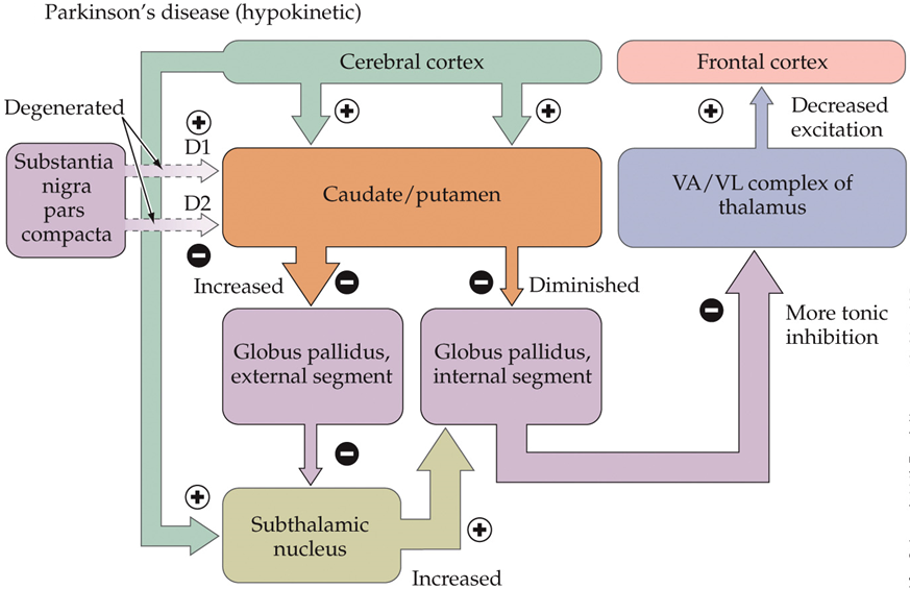 <ul><li><p>degeneration of dopaminergic neurons in SN pars compacta</p></li><li><p>loss of dopamine → inhibitory activity of basal ganglia is enhanced → reduces activation of upper motor neurons by thalamus → difficulty initatiating movement</p></li><li><p>loss of neuromelanin in SN</p></li></ul><p></p>