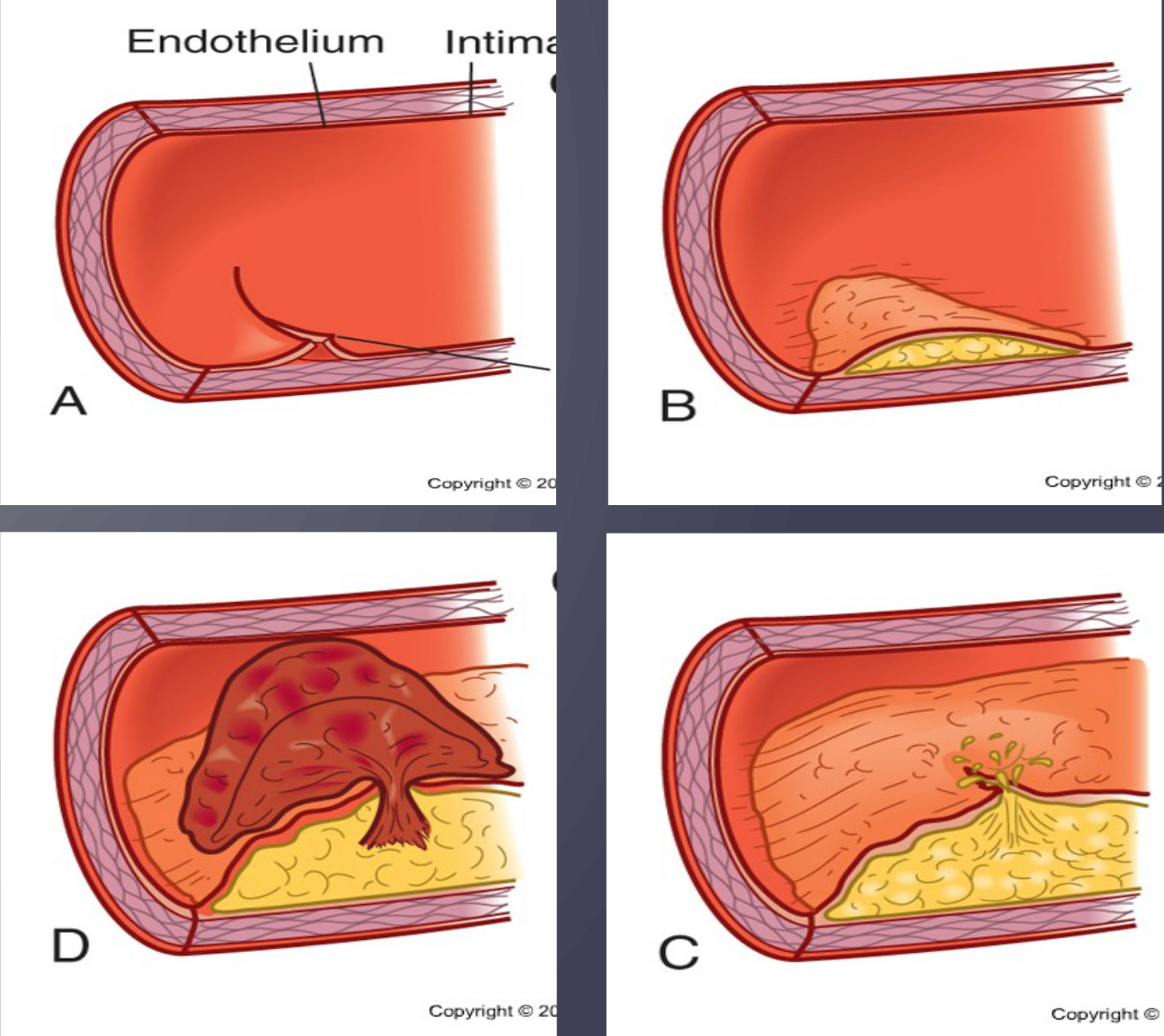 <p>“Hardening of arteries”</p><ul><li><p>Begins as soft deposits of fat that harden with age</p></li><li><p>Major cause of CAD</p></li></ul><p></p>