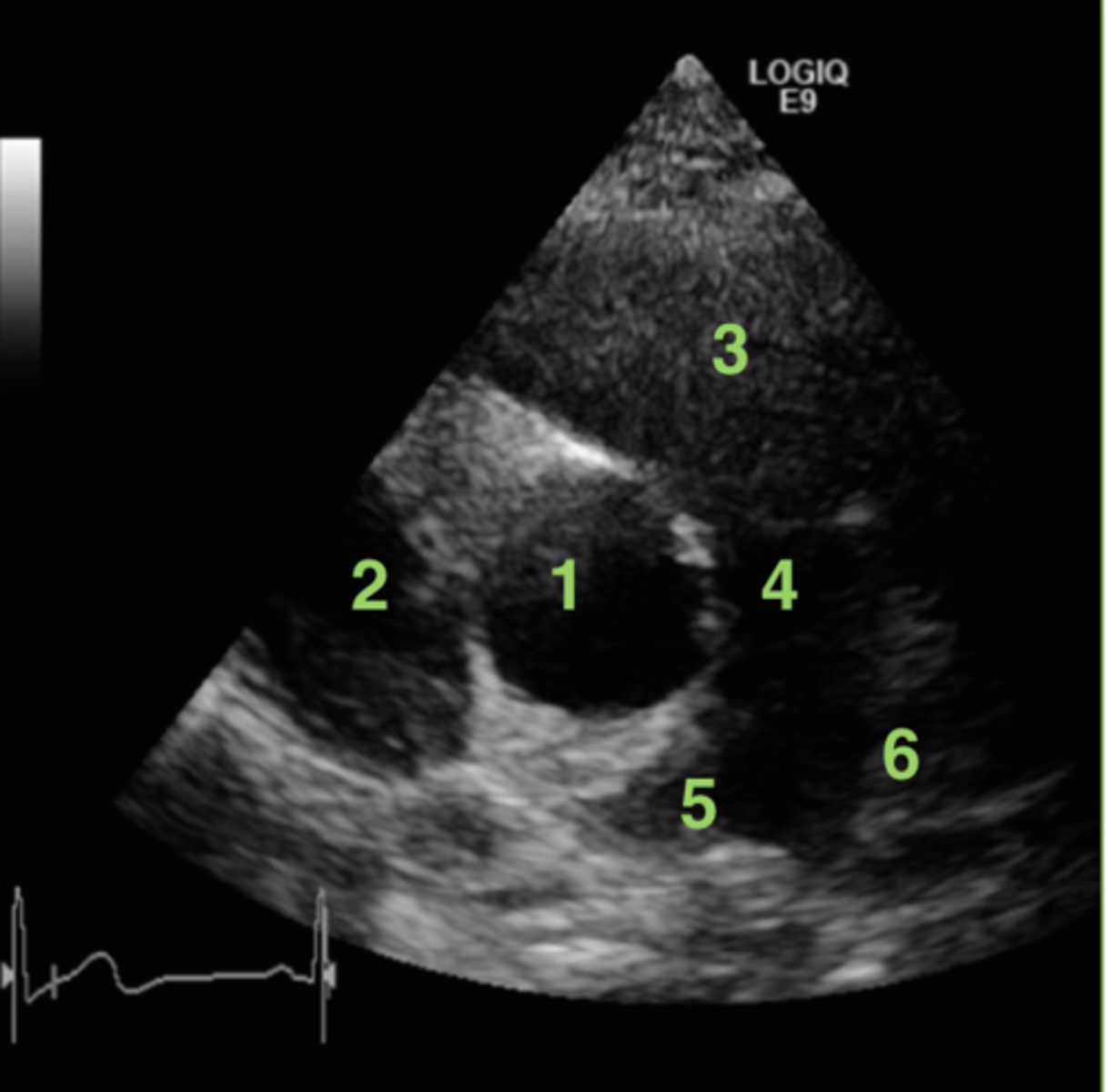 <p>right posterior pulmonic cusp</p>