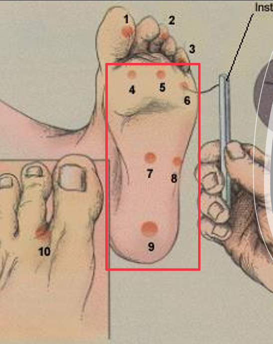 <ul><li><p><span><strong>1,3,5 Met heads</strong></span></p></li><li><p><span style="font-family: &quot;Times New Roman&quot;; line-height: normal; font-size: 7pt;"><strong> </strong></span><span><strong>Medial &amp; lateral midfoot</strong></span></p></li><li><p><span><strong>Heel</strong></span></p></li></ul><p></p>
