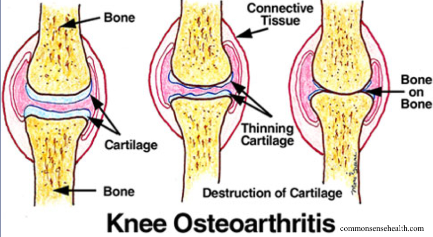 <ul><li><p><strong>An **impingement** C.P.L = HIPS!! Femoral Acetabular Impingement (genetic)</strong></p><ul><li><p>impingement: in there too tight</p></li><li><p>CPL wasn’t bone on bone until 35</p></li></ul></li><li><p>Progressive thinning of <strong>****<em><u>hyaline</u></em> cartilage</strong> </p><ul><li><p>leads us back to articular cartilage (ends of epiphyses)</p></li><li><p>articular cartilage is a type of hyaline</p></li><li><p>a lot of times cartilage is not heavily innervated w/ circulatory system, some of these cells are 6-8 cell links away from a capillary bed which means they don’t heal very quickly</p></li><li><p>the further that we have tissues away from capillary beds, the less blood flow they receive, the slower they are to heal</p></li></ul></li><li><p>Formation of **<strong>osteophytes</strong>** (a bone outgrowth! = **”<strong><em><u>bone spurs</u></em></strong>'“** of the heel)** <strong><em><u>exacerbate</u></em></strong> = Makes it WORSE!</p><ul><li><p>osteophytes: sometimes during bone remodeling, there’s these little extensions that come off, prominent in heel… can rub against calcaneal tendon, which inserts on calcaneus</p></li><li><p>bone spurs = no good</p></li></ul></li></ul><p></p>