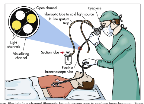 <p>It is used to examine the interior of a hollow viscus (e.g., digestive, respiratory, and urogenital organs and the endocrine system) or canal (e.g., bile ducts, pancreas). The instrument, a flexible or inflexible tube with a camera and light source, is inserted into a body orifice (Figure 5-4). Still and/or video images are recorded and biopsy specimens are obtained for tissue examination or other laboratory diagnostic tests </p>