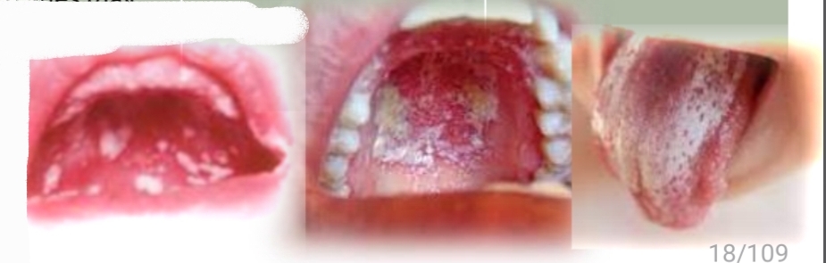 <p><strong><u>Pseudomembranous Candidiasis</u></strong></p><p class="has-focus">Candida albicans fungus (and other species)</p><p class="has-focus">Contributing factors: antibiotics, steroids, immune supression</p><p class="has-focus">Orthodontic appliances and toothbrushes may harbour fungus</p><p class="has-focus"></p><p class="has-focus is-empty"><strong>Treatment </strong>- Antifungals, proper oral hygiene. Reccurance if cause not eliminated</p><p class="has-focus"></p><p class="has-focus is-empty"><em>DD - Plaque, Chemical burn, Coated tongue, Mucosal sloughing, Superficial lip and cheek biting, Koplic spots of rubeola</em></p>