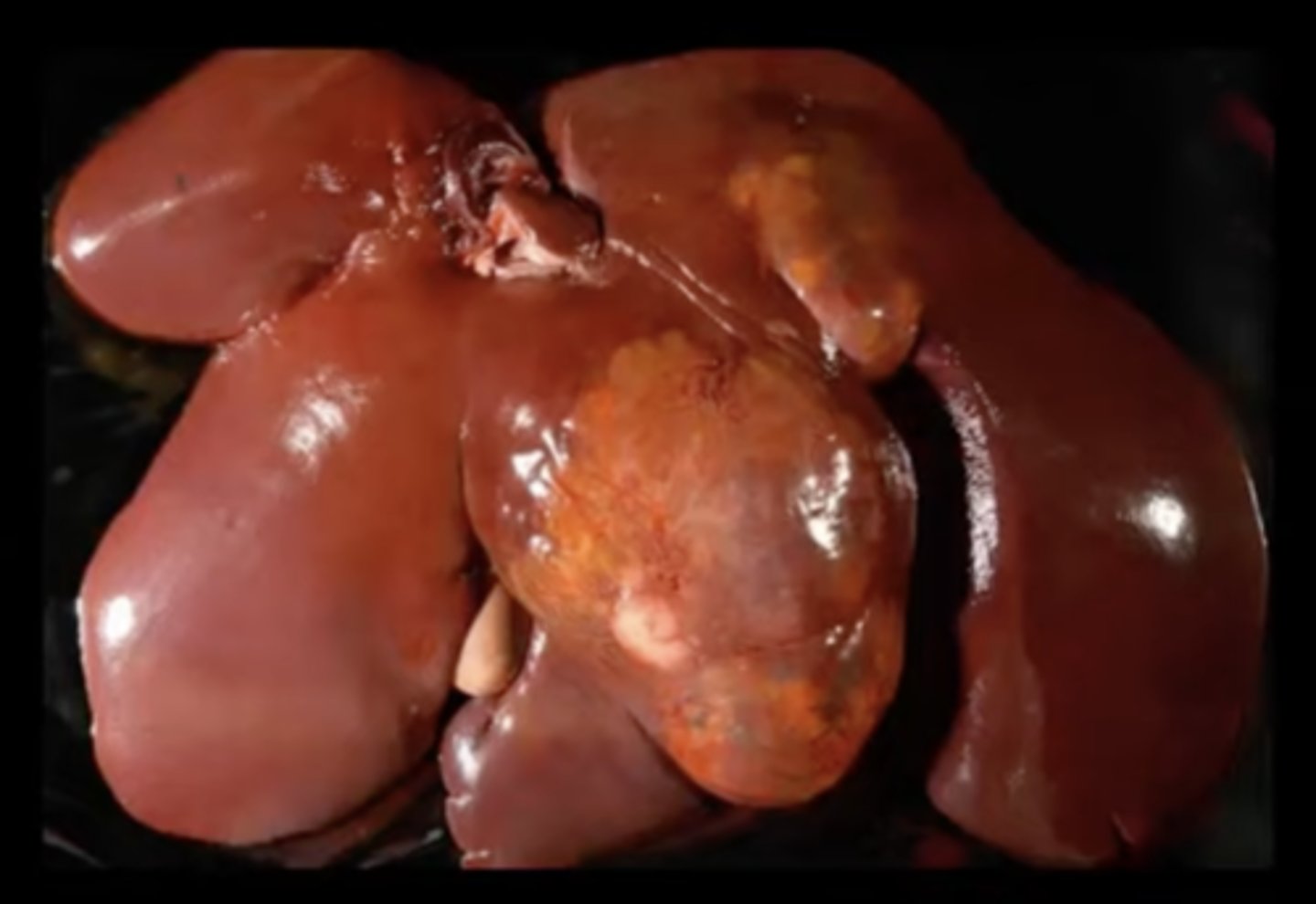 <p>What has caused this gross appearance of this liver?</p>