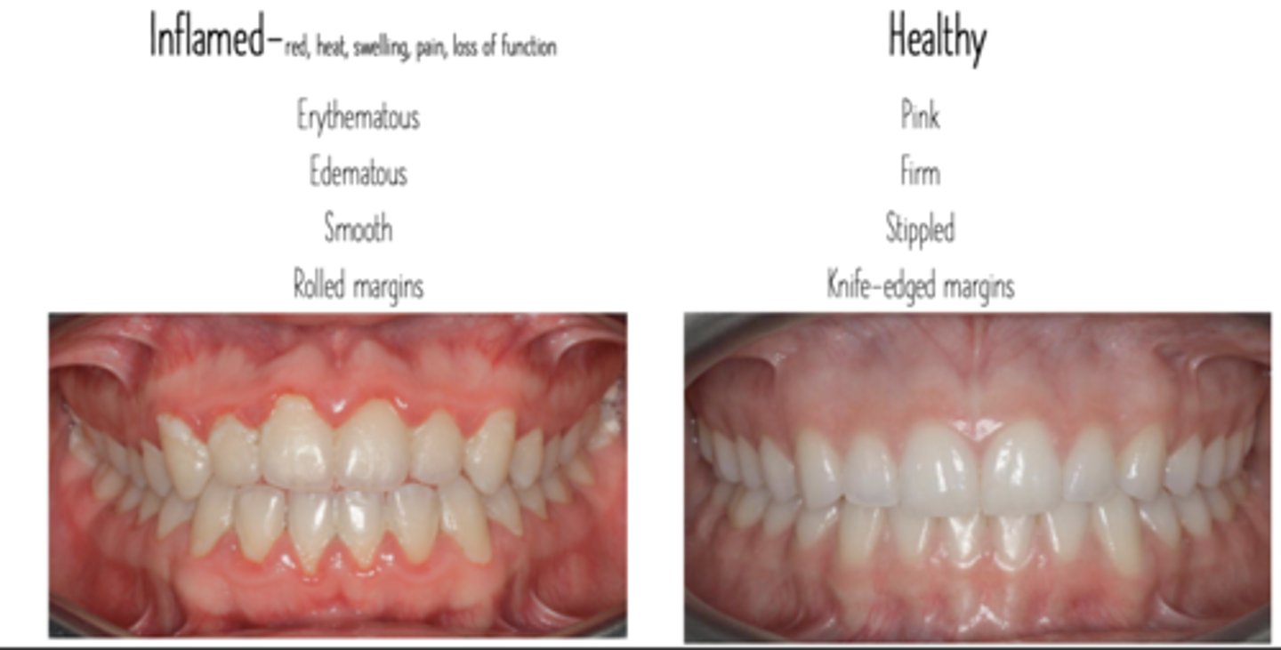 <p>Red</p><p>Heat</p><p>Swelling</p><p>Pain</p><p>Loss of function</p>