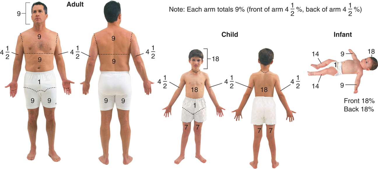 <ul><li><p><span><strong><span>****Helps estimate extent of burn area</span></strong></span></p></li><li><p><span><span>Adult body is divided into 11 main areas</span></span></p></li><li><p><span><span>Each represents 9 percent of body surface</span></span></p></li></ul><p></p>
