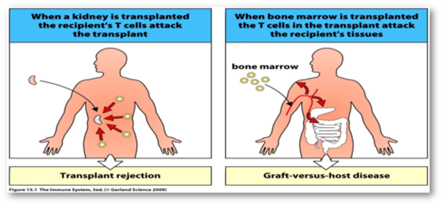 <p>graft attacks any host tissue bearing foreign MHC markers</p><p>effects are systemic and toxic</p><p>occurs within 100-300 days of the graft</p>