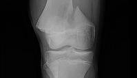 <p><strong>Refer to the figure.</strong> The _______is fractured in the most common epiphyseal injury pattern, a Salter–Harris ________:</p><p>a) femur; type 2</p><p>b) tibia; type 1</p><p>c) femur; type 1</p><p>d) tibia; type 2</p>