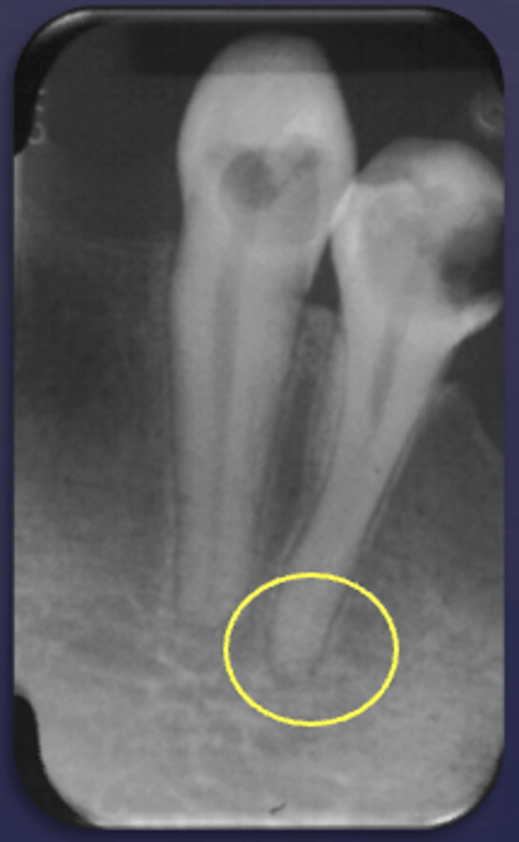 <p>What type of change is seen in this radiograph?</p>