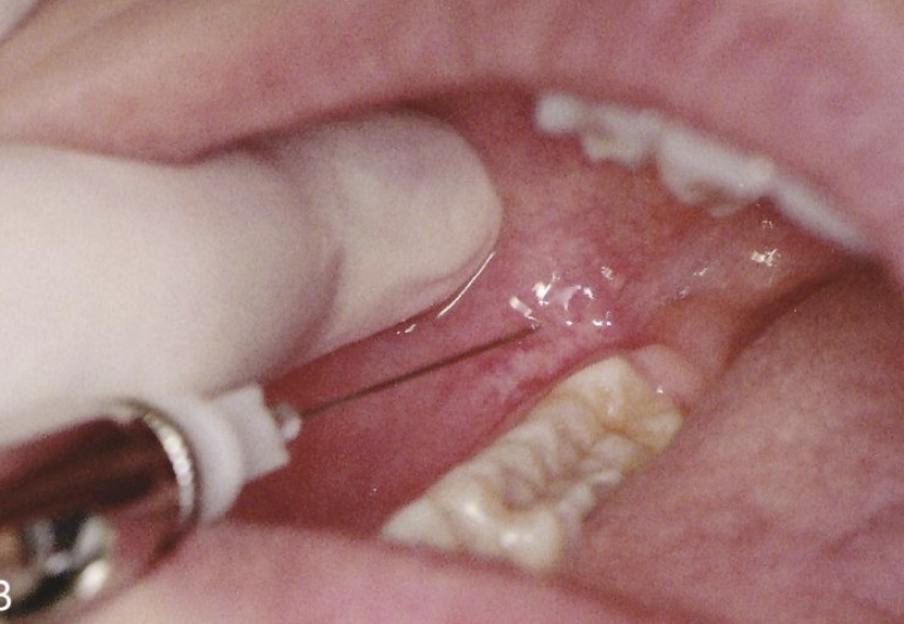 <ul><li><p>Insert in mucous membrane distal and buccal to most distal molar tooth in the arch</p></li><li><p>Orient bevel toward bone</p></li></ul><p></p>
