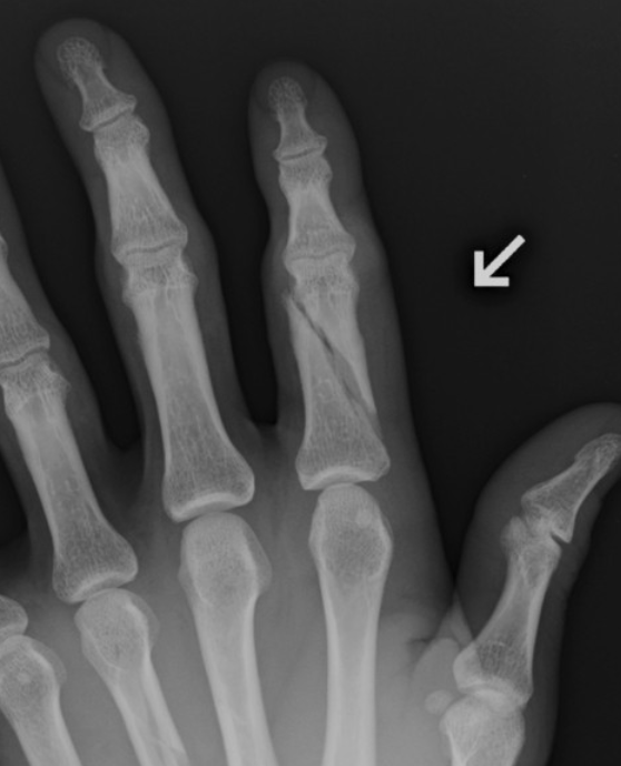<p>What type of fracture is this? (Bonus points for full explanation)</p>