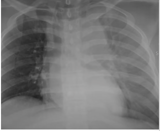 widened mediastinum 