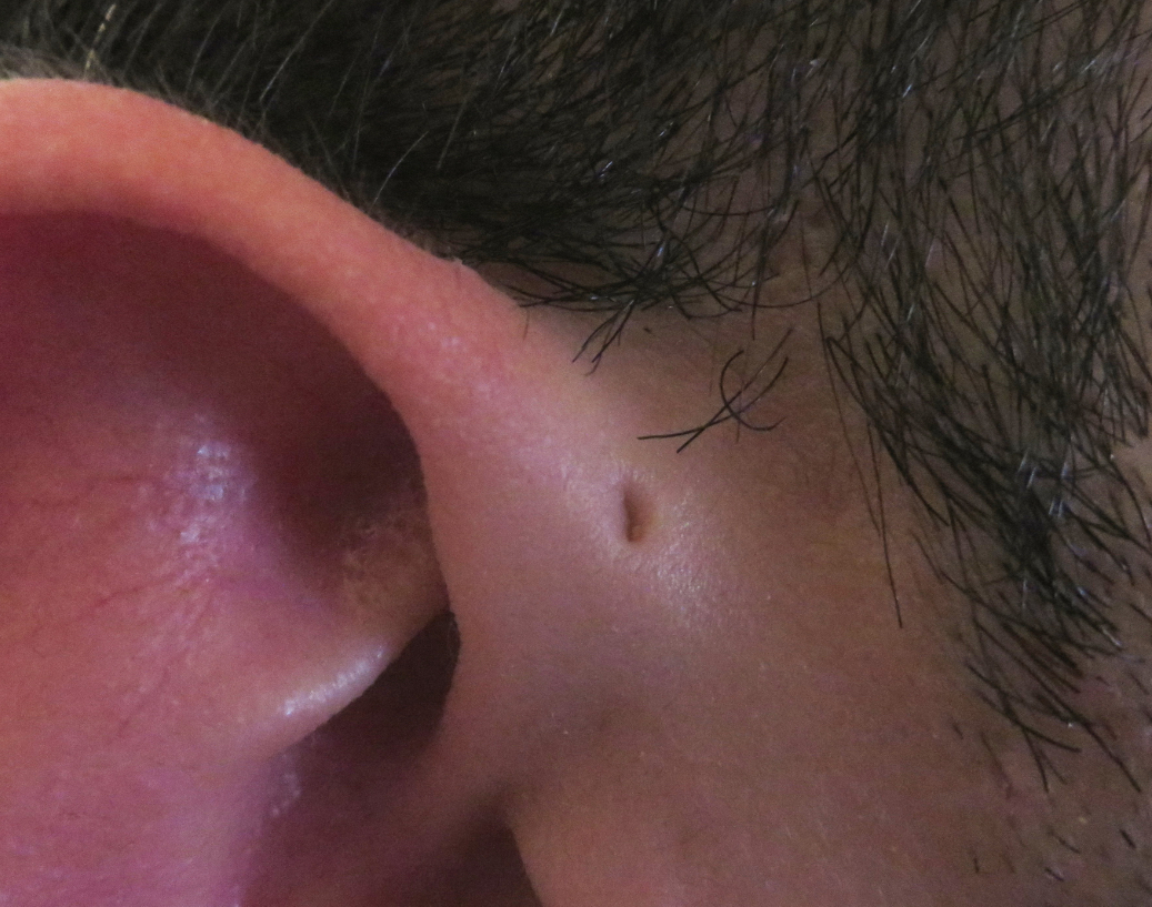<p>Location: Pinna</p><ul><li><p>Depression in skin</p></li><li><p>Anterior to helix + superior to tragus</p></li></ul><p></p>