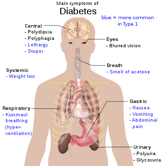 <ul><li><p>Chronic condition where the body doesn’t produce enough insulin</p></li><li><p><span>When there isn't enough insulin or cells stop responding to insulin, too much blood sugar stays in your bloodstream. Over time, that can lead to heart disease, vision loss, and kidney disease.</span></p></li><li><p><span>Type 2: body has trouble controlling blood sugar and using it for energy</span></p></li><li><p><span>Type 1: present since birth; pancreas makes little or no insulin, leading to high blood sugar levels</span></p></li><li><p><span>Prediabetes: blood sugar is higher than '“healthy”, but not high enough to be considered type 2</span></p></li><li><p><span>Gestational: causes high blood pressure during pregnancy</span></p></li></ul>