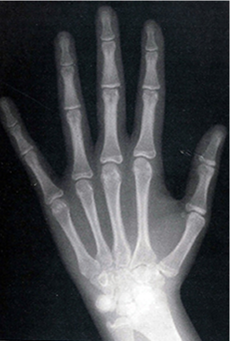 <p>outline hand wrist radiographs </p>