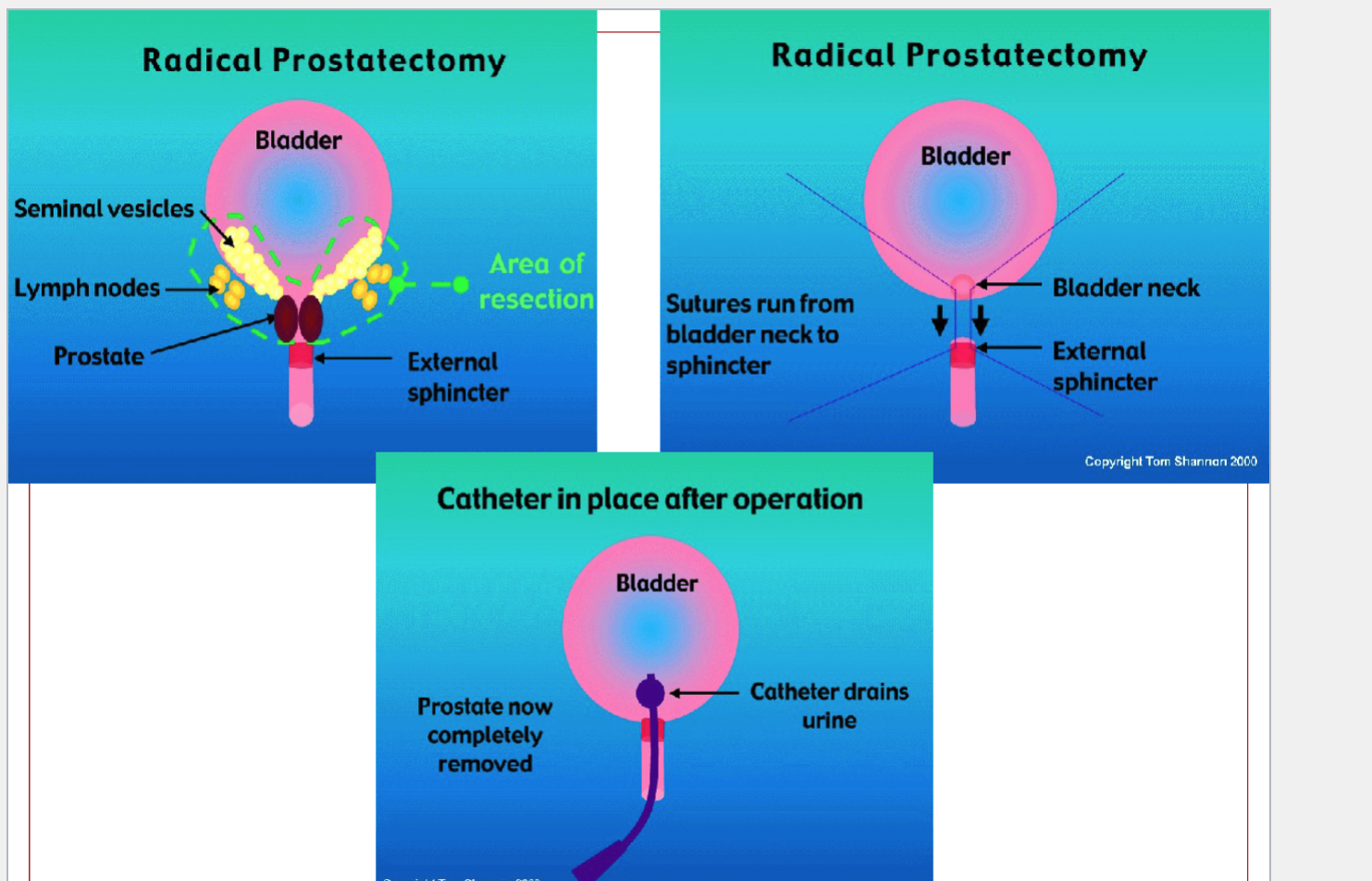 <p><strong>Laparoscopic Radical Prostatectomy (LRP)</strong></p><p>A minimally invasive version of the same surgery.</p><p><strong>Key features:</strong></p><ul><li><p>Several <strong>small incisions</strong> (instead of one large one)</p></li><li><p>A camera and fine instruments are used</p></li><li><p>Can be done <strong>with or without robotic assistance</strong> (e.g., Da Vinci robot)</p></li></ul><p><strong>How it differs from the open approach</strong></p><table style="min-width: 75px;"><colgroup><col style="min-width: 25px;"><col style="min-width: 25px;"><col style="min-width: 25px;"></colgroup><tbody><tr><th colspan="1" rowspan="1"><p>Feature</p></th><th colspan="1" rowspan="1"><p>Laparoscopic Radical Prostatectomy (LRP)</p></th><th colspan="1" rowspan="1"><p>Open Radical Prostatectomy</p></th></tr><tr><td colspan="1" rowspan="1"><p>Incisions</p></td><td colspan="1" rowspan="1"><p>Small (keyhole)</p></td><td colspan="1" rowspan="1"><p>One large incision</p></td></tr><tr><td colspan="1" rowspan="1"><p>Recovery</p></td><td colspan="1" rowspan="1"><p>Faster</p></td><td colspan="1" rowspan="1"><p>Longer</p></td></tr><tr><td colspan="1" rowspan="1"><p>Blood loss</p></td><td colspan="1" rowspan="1"><p>Less</p></td><td colspan="1" rowspan="1"><p>More</p></td></tr><tr><td colspan="1" rowspan="1"><p>Pain</p></td><td colspan="1" rowspan="1"><p>Less postoperative pain</p></td><td colspan="1" rowspan="1"><p>More pain</p></td></tr><tr><td colspan="1" rowspan="1"><p>Visualization</p></td><td colspan="1" rowspan="1"><p>Excellent (camera magnification)</p></td><td colspan="1" rowspan="1"><p>Normal</p></td></tr><tr><td colspan="1" rowspan="1"><p>What is removed?</p></td><td colspan="1" rowspan="1"><p><strong>Same:</strong> entire prostate + surrounding tissues</p></td><td colspan="1" rowspan="1"><p><strong>Same:</strong> entire prostate + surrounding tissues</p></td></tr></tbody></table><p><span data-name="arrow_right" data-type="emoji">➡</span> <strong>Both surgeries remove the whole prostate—the only difference is the surgical method and recovery.</strong></p>