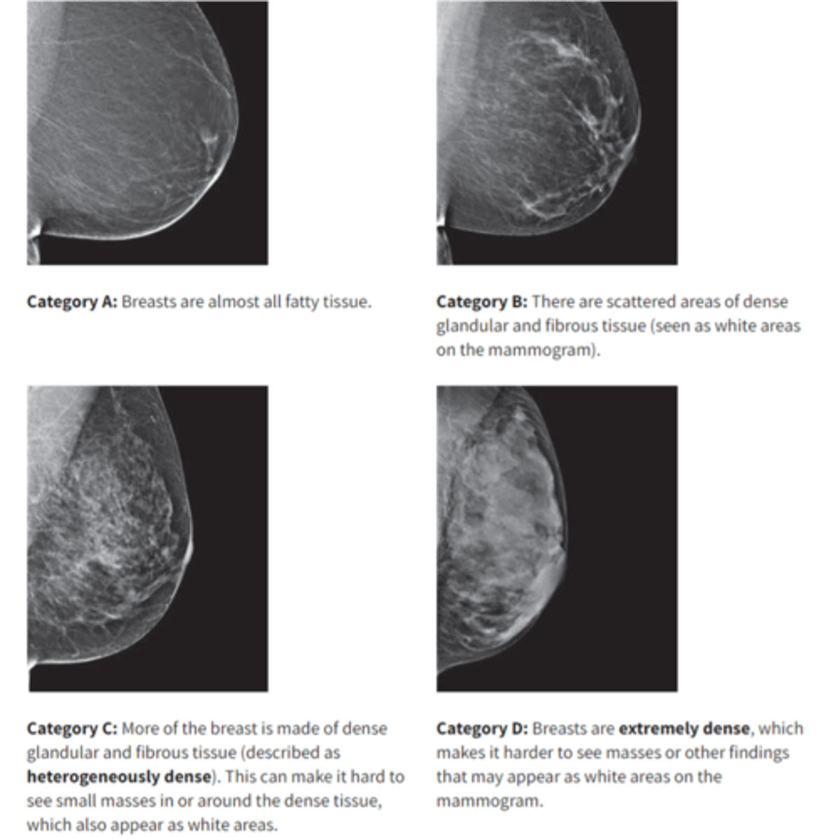 <p>A- Almost entirely fatty</p><p>B- Scattered areas of fibroglandular density</p><p>C- Heterogeneously dense</p><p>D- Extremely dense</p>