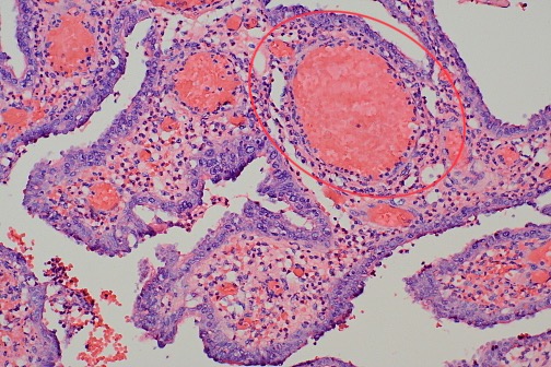<ol><li><p>Is the encircled vessel undergoing acute or chronic inflammation?</p></li><li><p>Why?</p></li></ol>