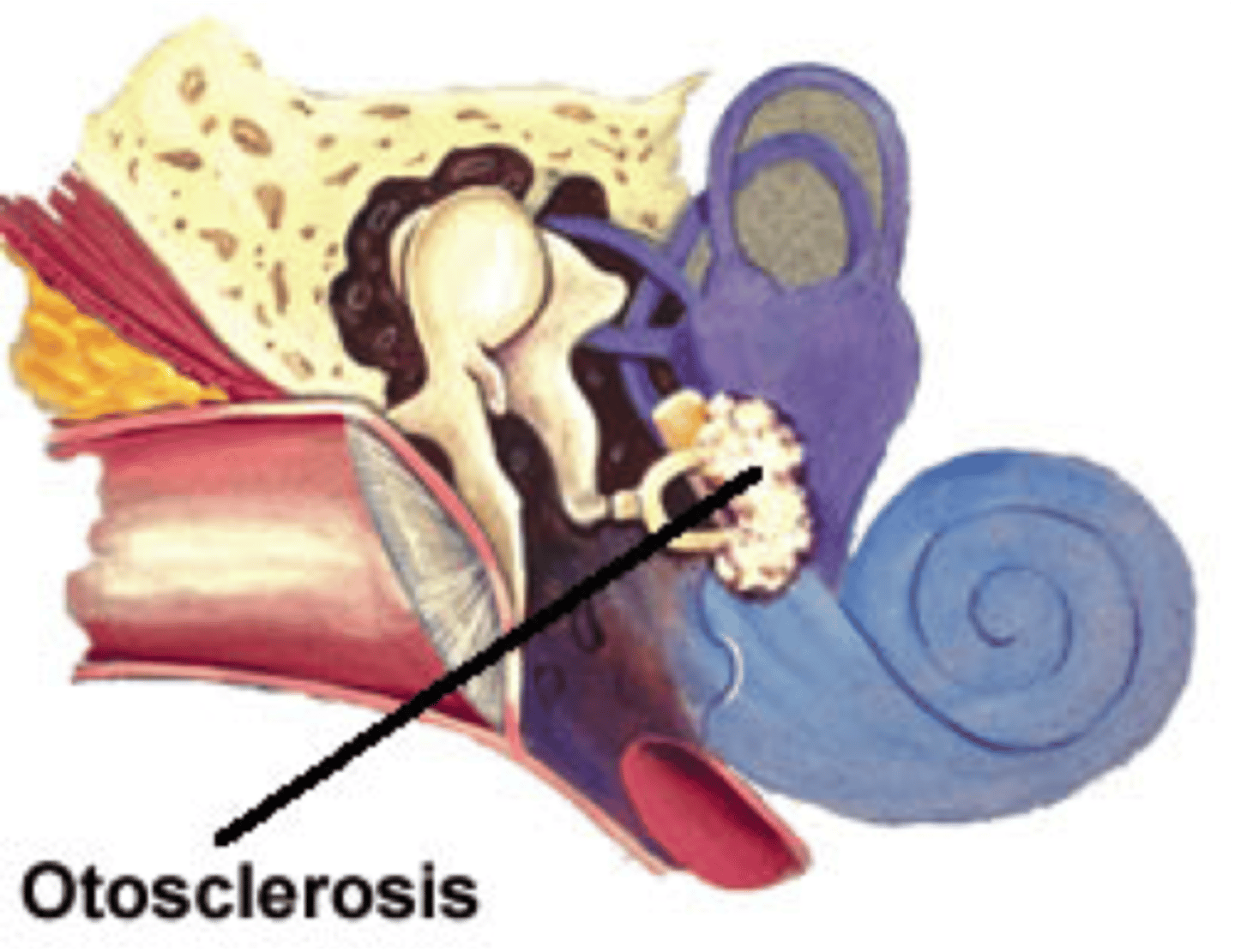<p>A bony degenerative disease process that can involve the stapes footplate and/or the cochlea; also called otospongiosis.</p>