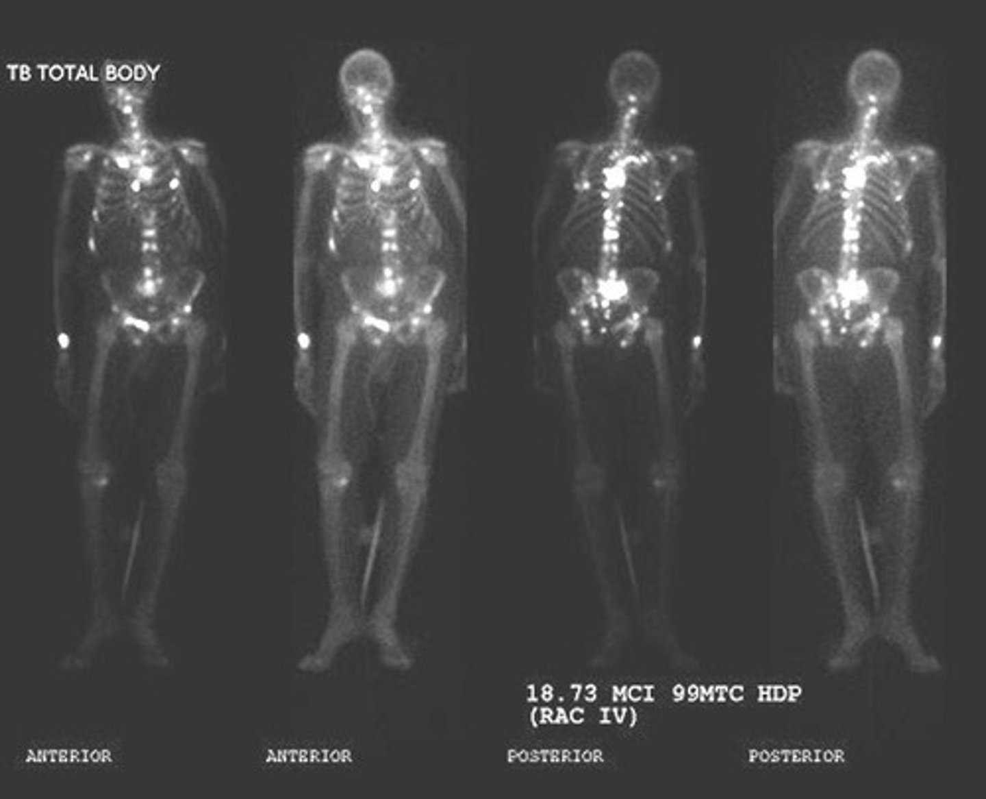 <p>Prostate, breast, lung, melanoma, urinary bladder, and cervix cancers.</p>
