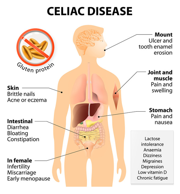 <ul><li><p>An immune reaction to eating gluten, a protein found in wheat, barley, and rye</p></li><li><p>Over time the lining of the intestines wears away which can lead to malabsorption of nutrients</p></li><li><p><span>Symptoms include bloating, weight loss (can lead to missed periods), pale bad-smelling stool, numb or tingling in legs, tingling, infertility, gas, fatigue, low blood count (anemia), and osteoporosis</span></p></li></ul>