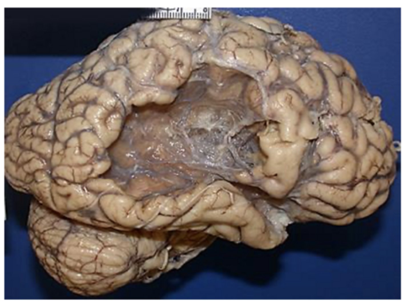 <p>old MCA infarct -> not the cause of death, but can see the changes/damage post-mortem from a previously experienced MCA infarct</p>