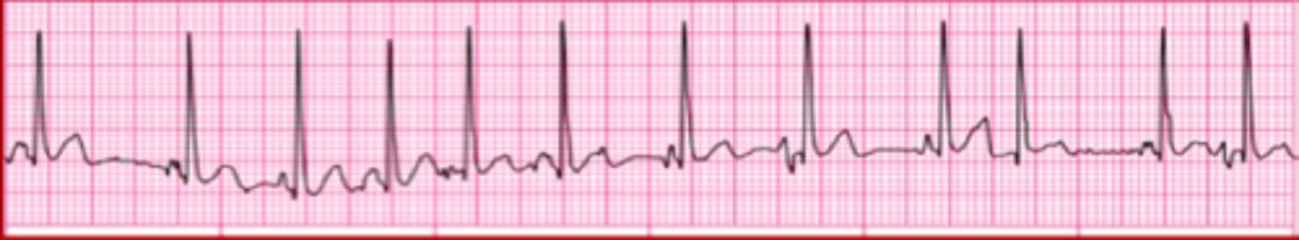 <p>Which Arrythmia is this?</p>