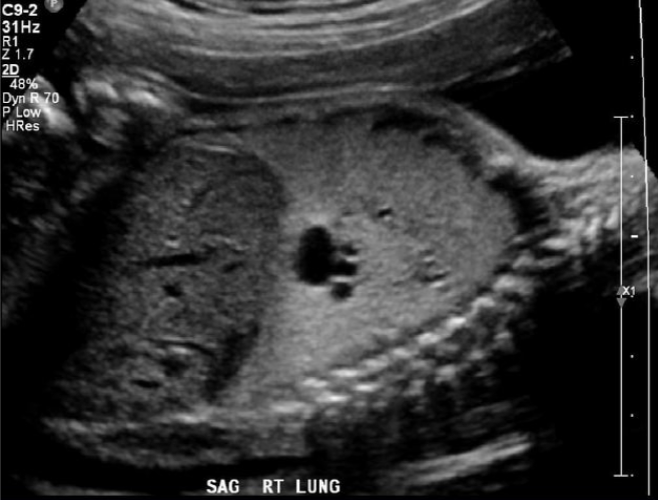 <p>Multicystic mass within lung made up of primitive lung tissue and bronchial-type structures</p>