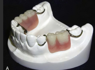 <ul><li><p>through contact between a rigid element on the denture and a rigid element on the abutment teeth </p></li></ul><p></p>