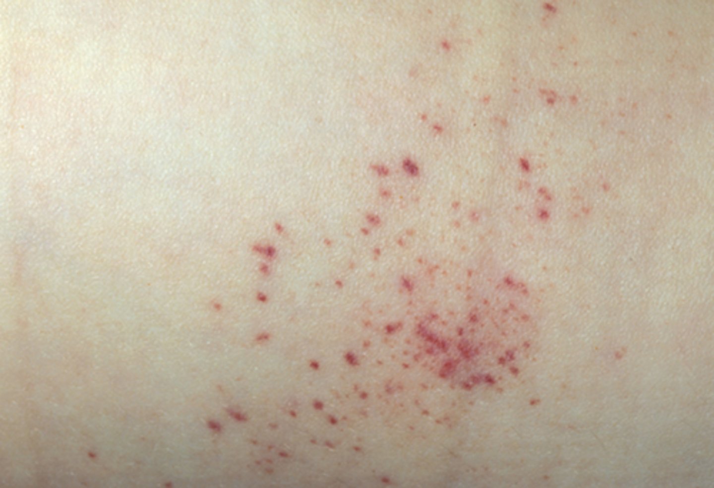 <p>blood in the skin, less than 4 mm</p>
