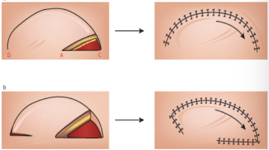 <p><strong><u>Local</u></strong>: has blood supply from <strong>at least one artery &amp; vein that relies on perforators for vascularization, </strong>can use<strong> adjacent tissue rotated in an arc</strong> to close defect</p><p><strong><u>Pedicled</u>: </strong>has <strong>blood supply from at least one artery &amp; vein that relies on perforators for vascularization, rotated</strong></p><p><strong><u>Free</u>: </strong>a blood vessel is cut and reconnected via anastomosis </p><p>-<strong>monitor w/ Doppler US for vascular supply pre and post operation</strong><br>-AVOID smoking and hyperglycemia </p>