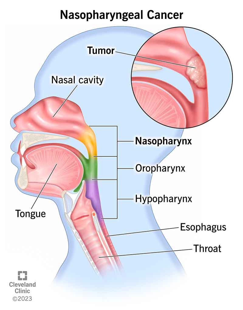 <p>Surgery: NPC not accessible to surgery</p><p>RTT: Most common modality</p><p>Chemo: concomitant with RTT for stages II &amp; IV</p><p>&nbsp;</p>