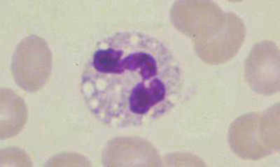 <p>__________________ can occur to neutrophils under the same conditions that cause Dohle bodies and toxic granulation (bacterial infections, burns, stress). </p>