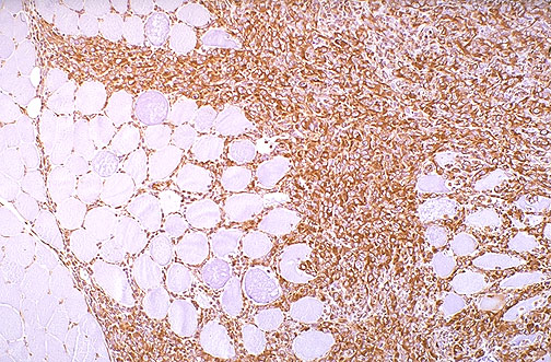 <ol><li><p>Immunohistochemical marker for sarcoma</p></li><li><p>Contrast between sarcoma cells and muscle fibers</p></li></ol><p></p>