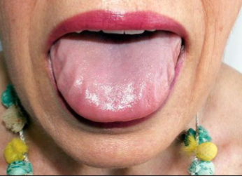 <p>presents with thick lips and macroglossia</p>