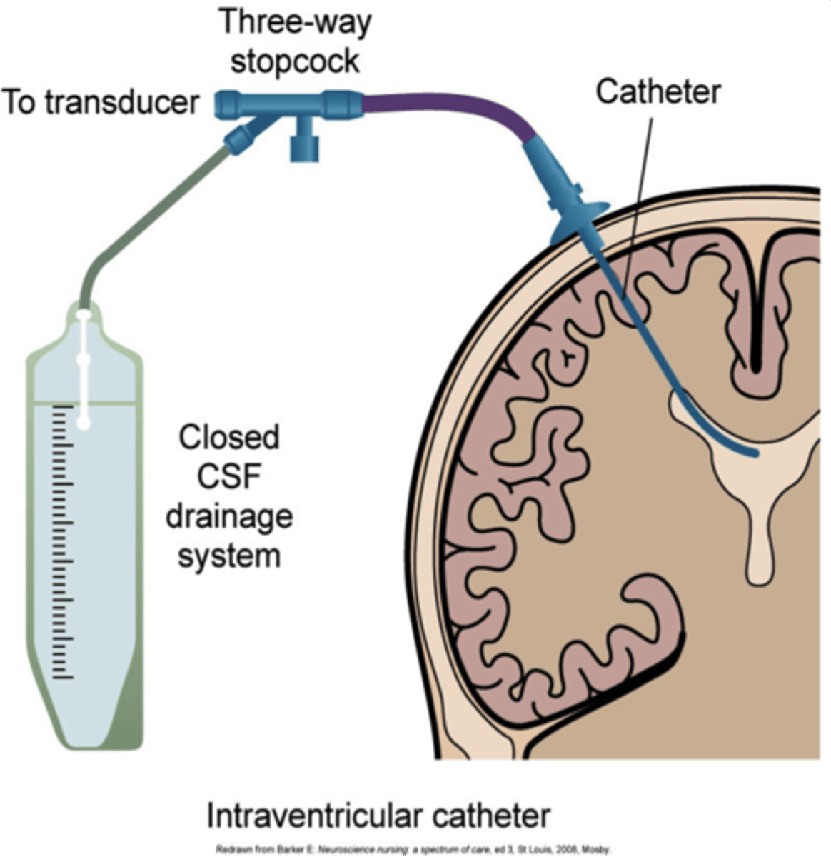 <p>Soft tube put through burr hole. for ICP, drains excess CSF. Increased risk for infection.</p>