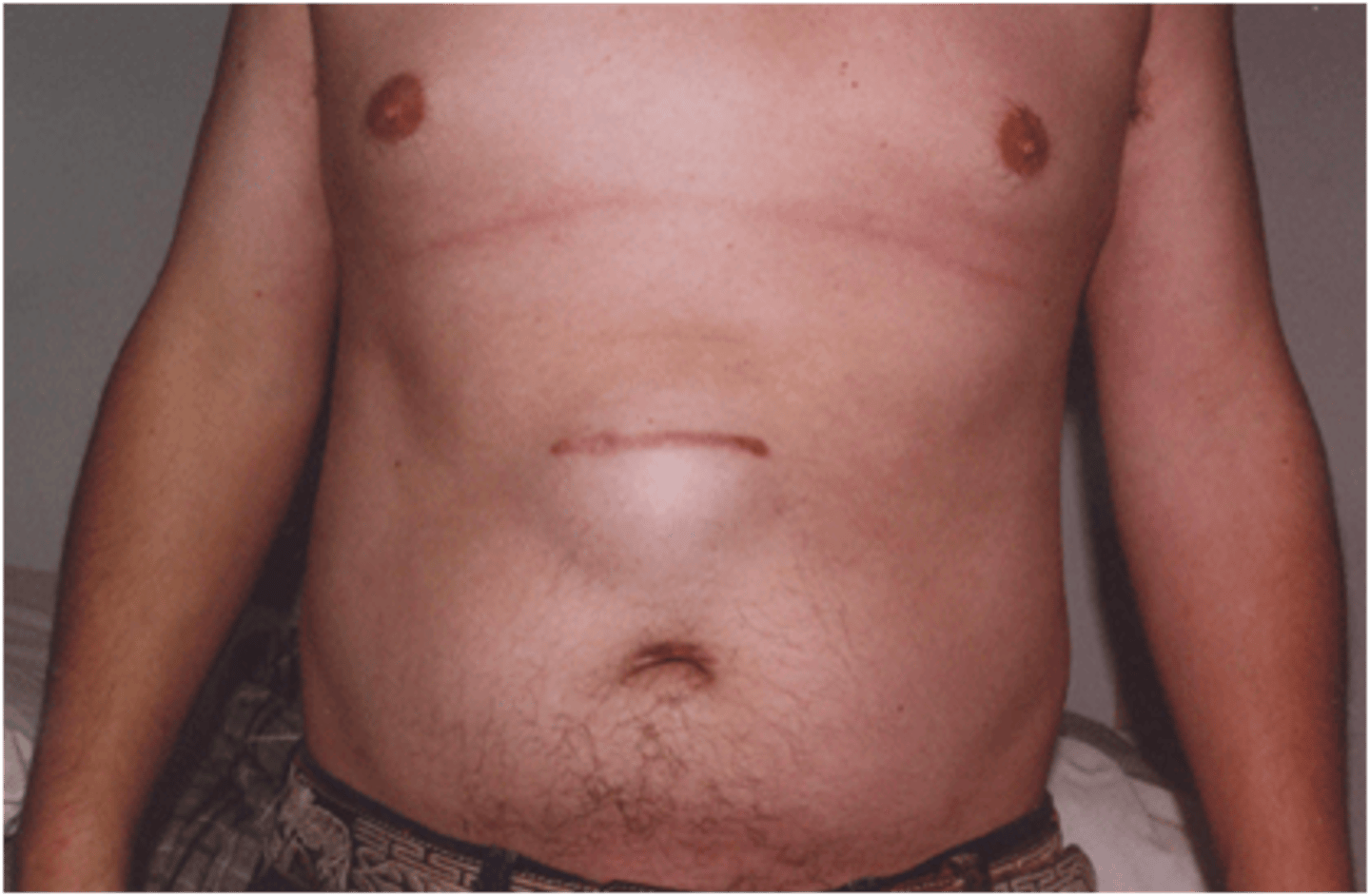<p>A type of hernia caused by an incompletely-healed surgical wound</p>