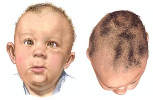 <p><strong><em>Asymmetric</em></strong></p><ul><li><p>unilateral occipital flattening </p></li><li><p>ipsilateral forehead bossing </p></li><li><p>ipsilateral anterior ear shift </p></li><li><p>contralateral occipital prominence </p></li><li><p>contralateral forehead flattening </p></li><li><p>associated with congenital  muscular torticollis ~90%</p></li></ul><p></p>