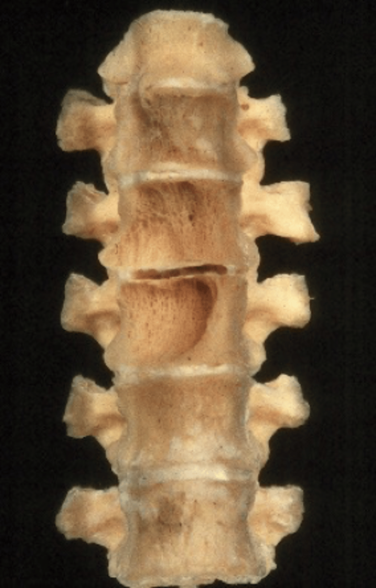 <p>ID skeletal metastasis</p>