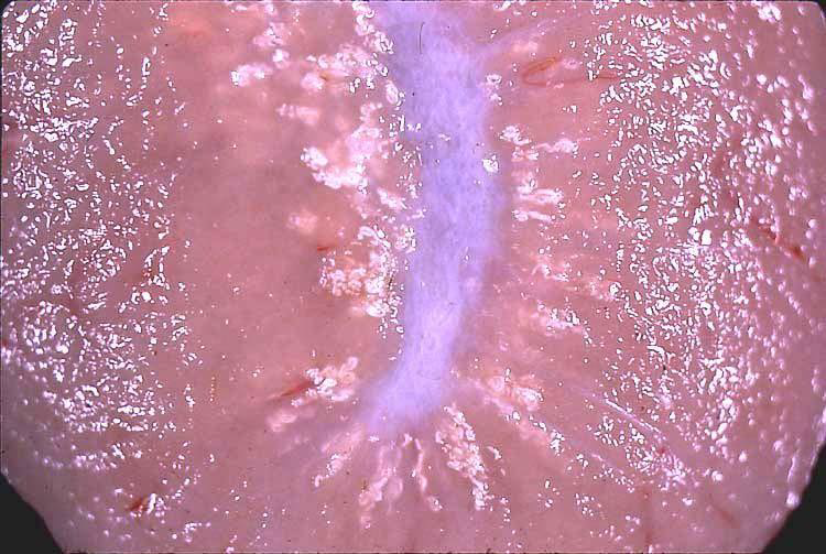 <p>Form of calcification caused by <strong><u>persistent elevated calcium level</u></strong> and <strong><u>extra-renal lesion of uremia</u></strong></p>