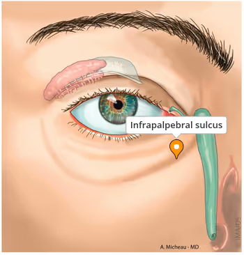 <p>Inferior palpebral sulci</p><p>(May actually end in sulcus) </p>
