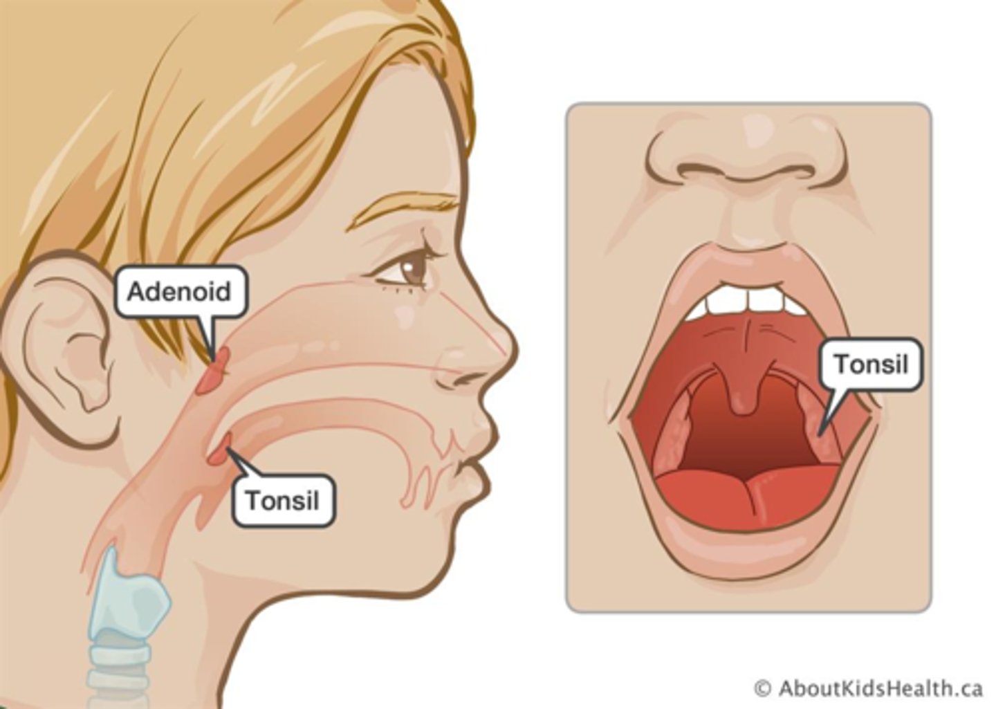 <p>Another type of excess immune tissue found in the head to fight off infection.</p>