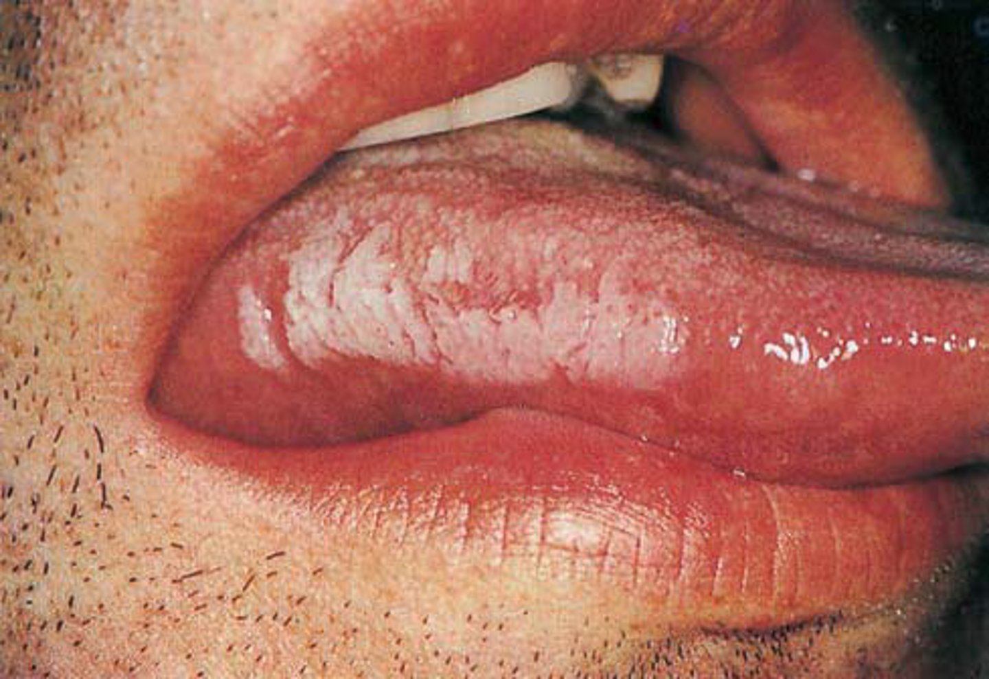 <p>Irregular corrugated white lesion most commonly occurring on the lateral border of the</p><p>tongue</p>