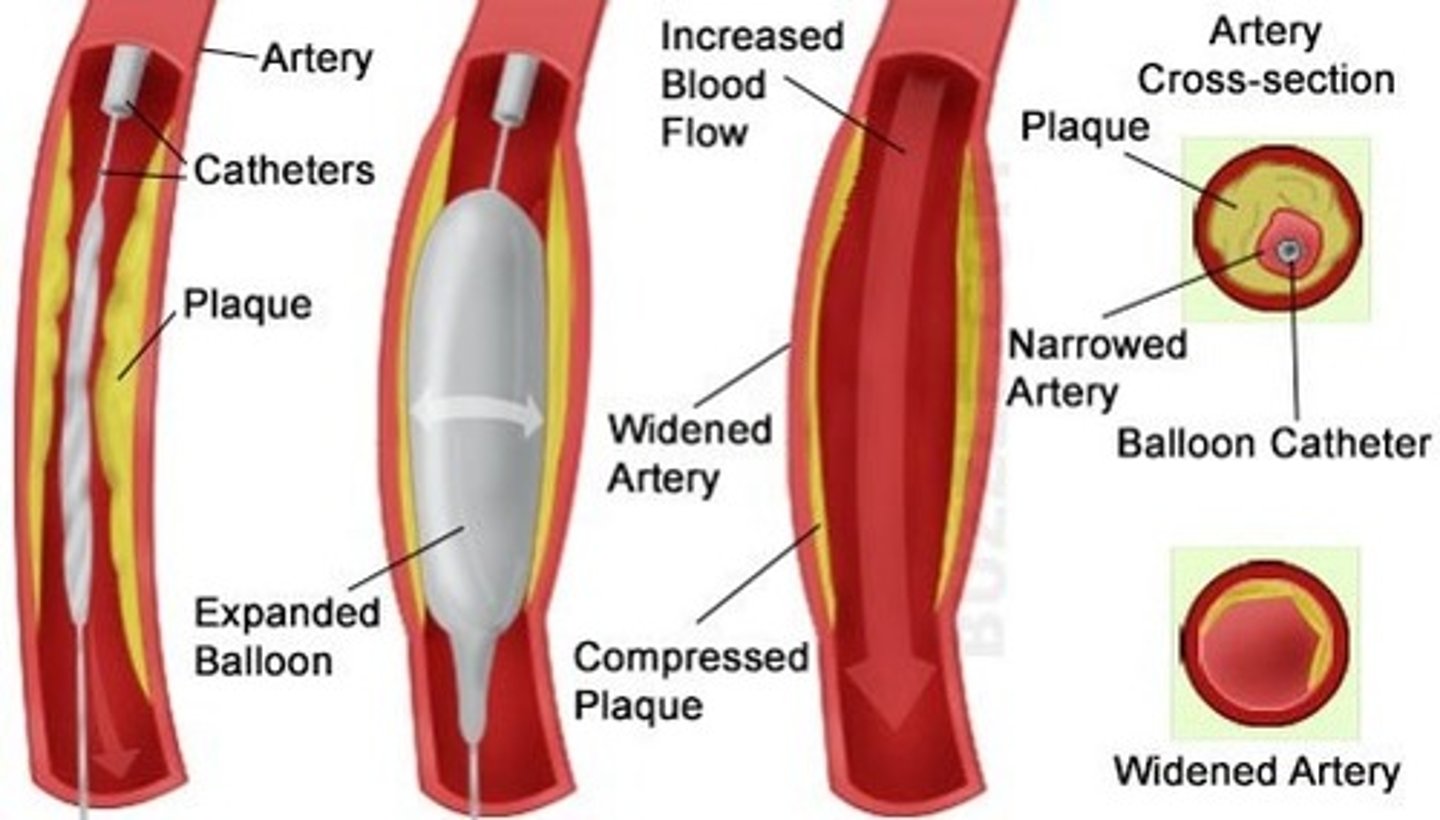 <p>a narrow balloon is inserted into the blocked vessel. It is then inflated, expanding the vessel.</p>