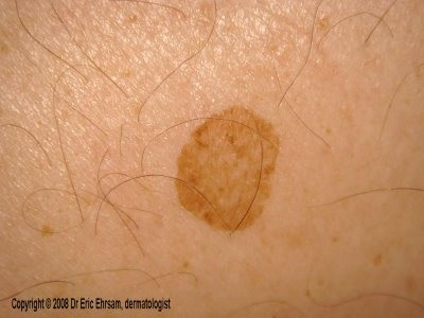<p>a flat area of color change and a non-palpable skin lesion</p><p>ex. freckles</p>