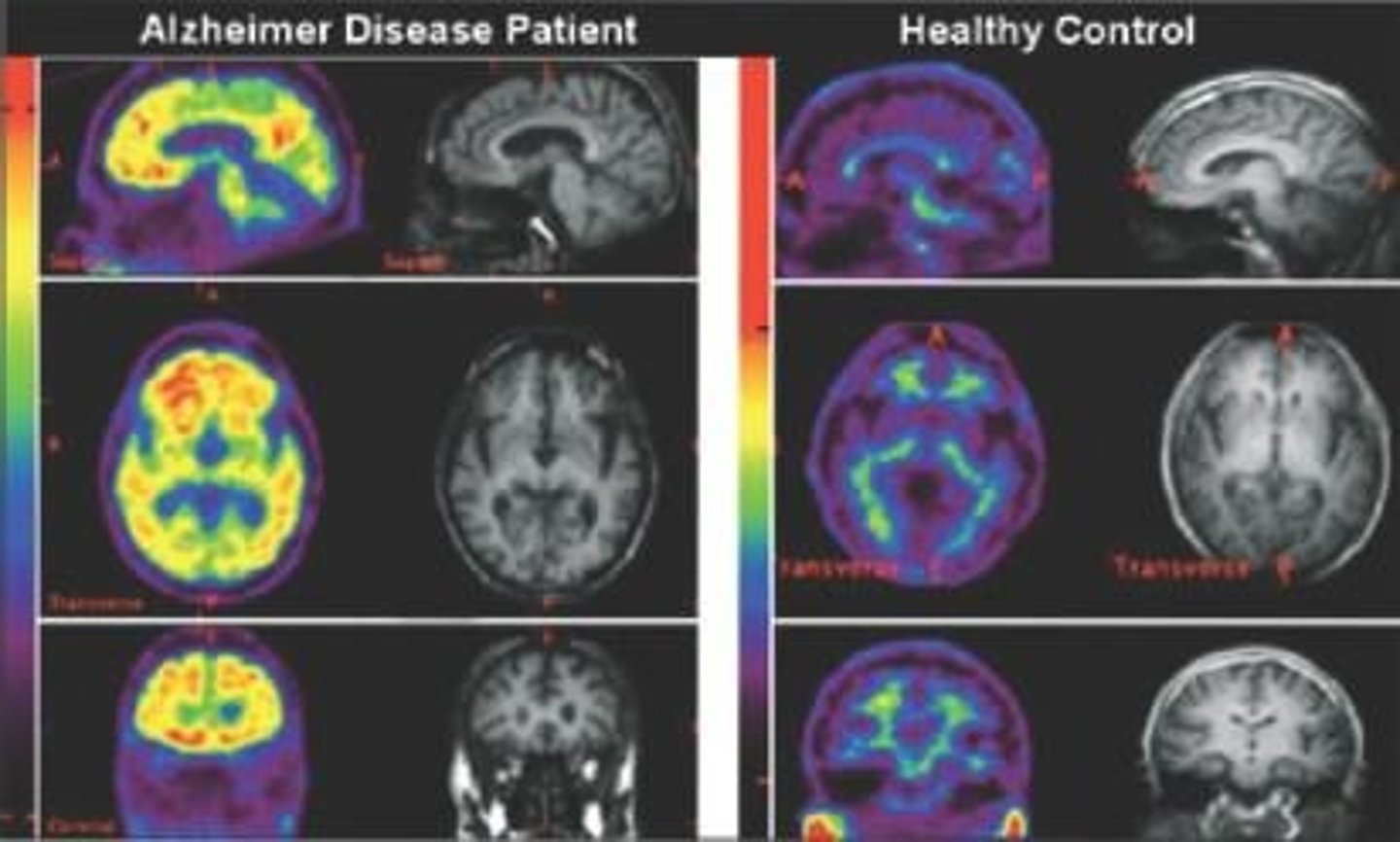<p>Identified in the brain using a PET scan that shows much more amyloid in patients with Alzheimer's disease compared to healthy individuals</p>