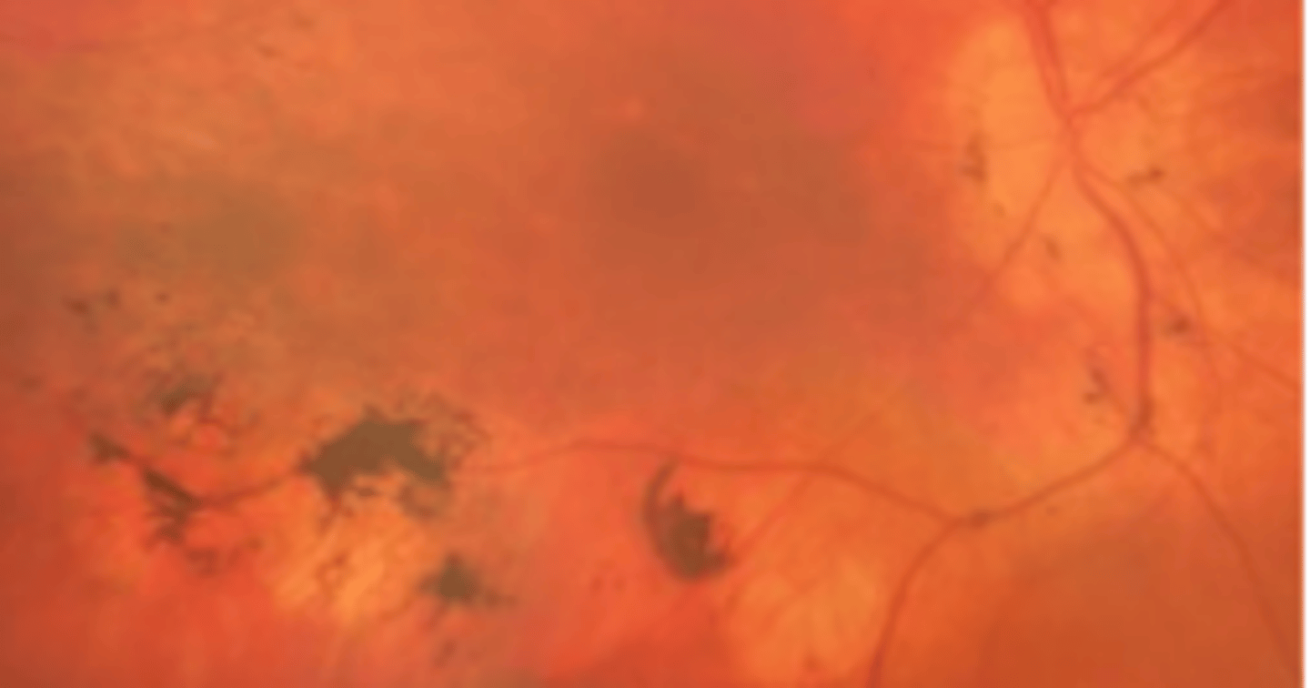 <p>atypical RP emanating from the disc and extending along the arcades</p>