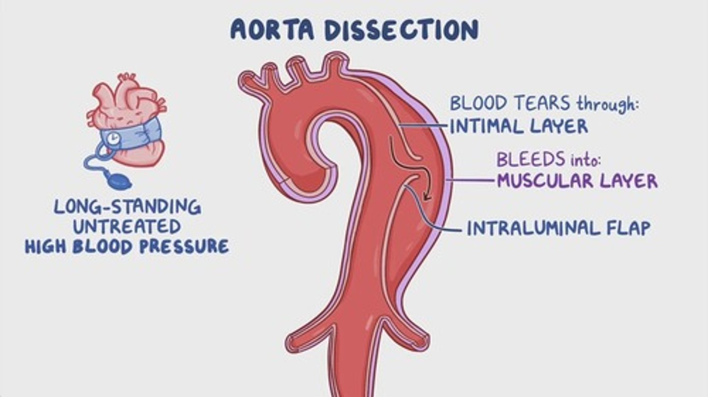 <p>High blood pressure, a risk factor for dissections.</p>